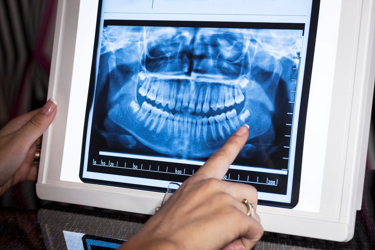 Dentes do siso: 6 dúvidas esclarecidas para manter o sorriso